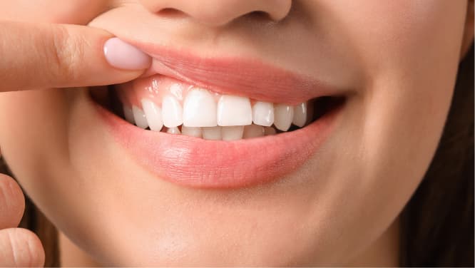 imagem de mulher sorrindo com dedo levantando o lábio superior para mostrar a arcada dentária, cirurgias periodontais, procedimento odontológico da periodontia