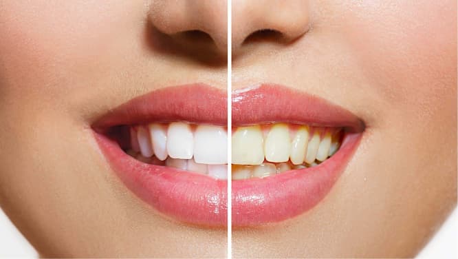 imagem antes e depois de clareamento dental, procedimentos odontológicos, odontologia estética