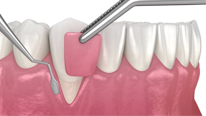 imagem 3d de demonstração do procedimento de enxertos gengivais, procedimento odontológico da periodontia