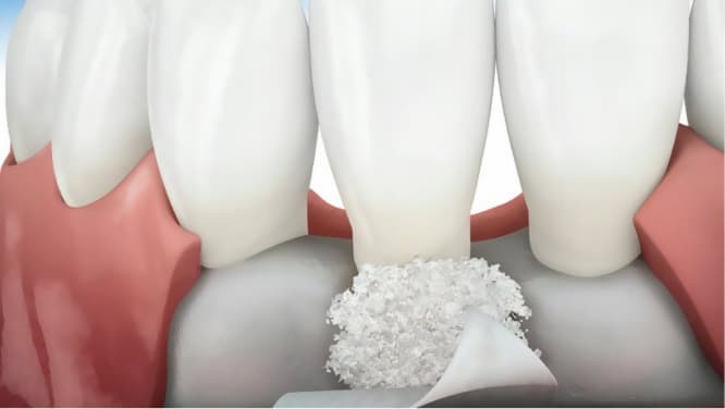 imagem demonstração 3d de enxerto dentário, procedimento odontológico, implantodontia
