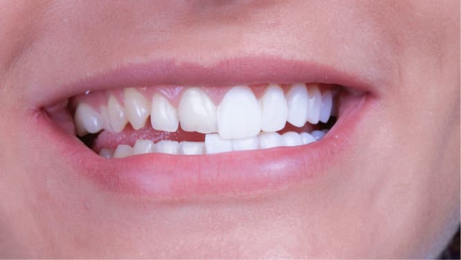 imagem antes e depois de aplicação de facetas de porcelana nos dentes, procedimentos odontológicos, odontologia estética