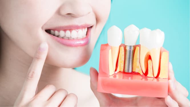 imagem mulher segurando exemplo de implantes, procedimento odontológico implantodontia, implantes dentários, implantes únicos