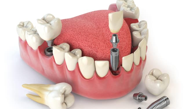 imagem objeto de demonstração arcada dentária com implantes dentários, procedimento odontológico, implantodontia