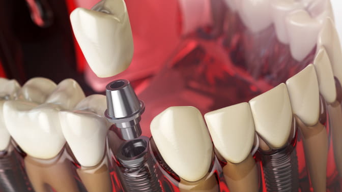 imagem procedimentos odontológicos implantodontia