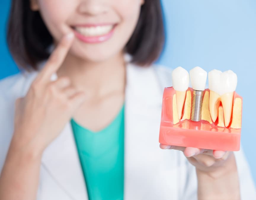 imagem mulher segurando objeto demonstrativo de implantes dentários, procedimento odontológico, implantodontia