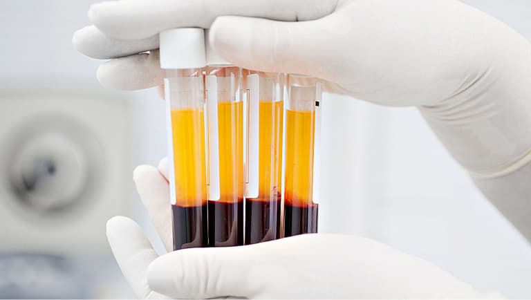 imagem frascos de prf, fibrina rica em plaquetas, procedimento harmonização orofacial