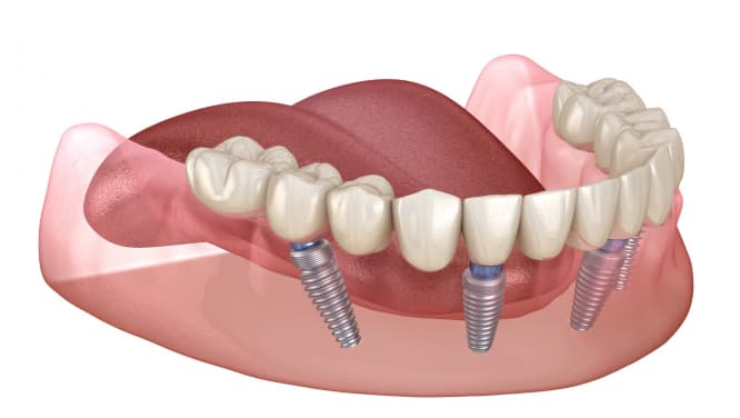 imagem demonstração 3d de protocolos dentários, procedimento odontológico, implantodontia