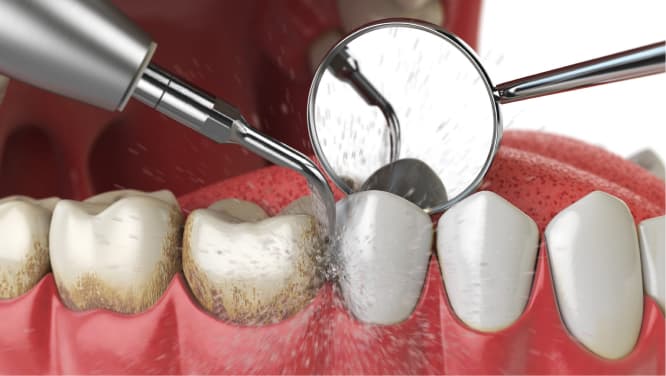 imagem 3d de demonstração do procedimento de raspagem e alisamento radicular de dentes, procedimento odontológico da periodontia