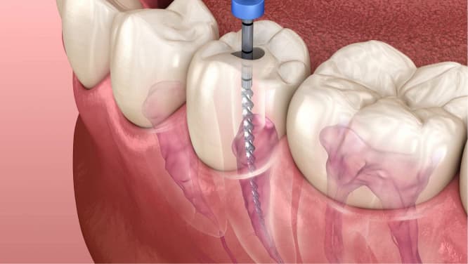 imagem 3d de demonstração de parte da arcada dentária e gengivas, tratamento endodôntico mecanizado, procedimento odontológico da endodontia