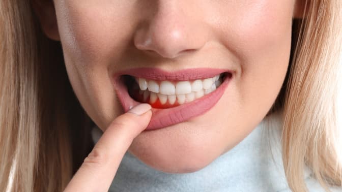 imagem procedimentos odontológicos periodontia, mulher com dedo nos lábios, mostrando a gengiva